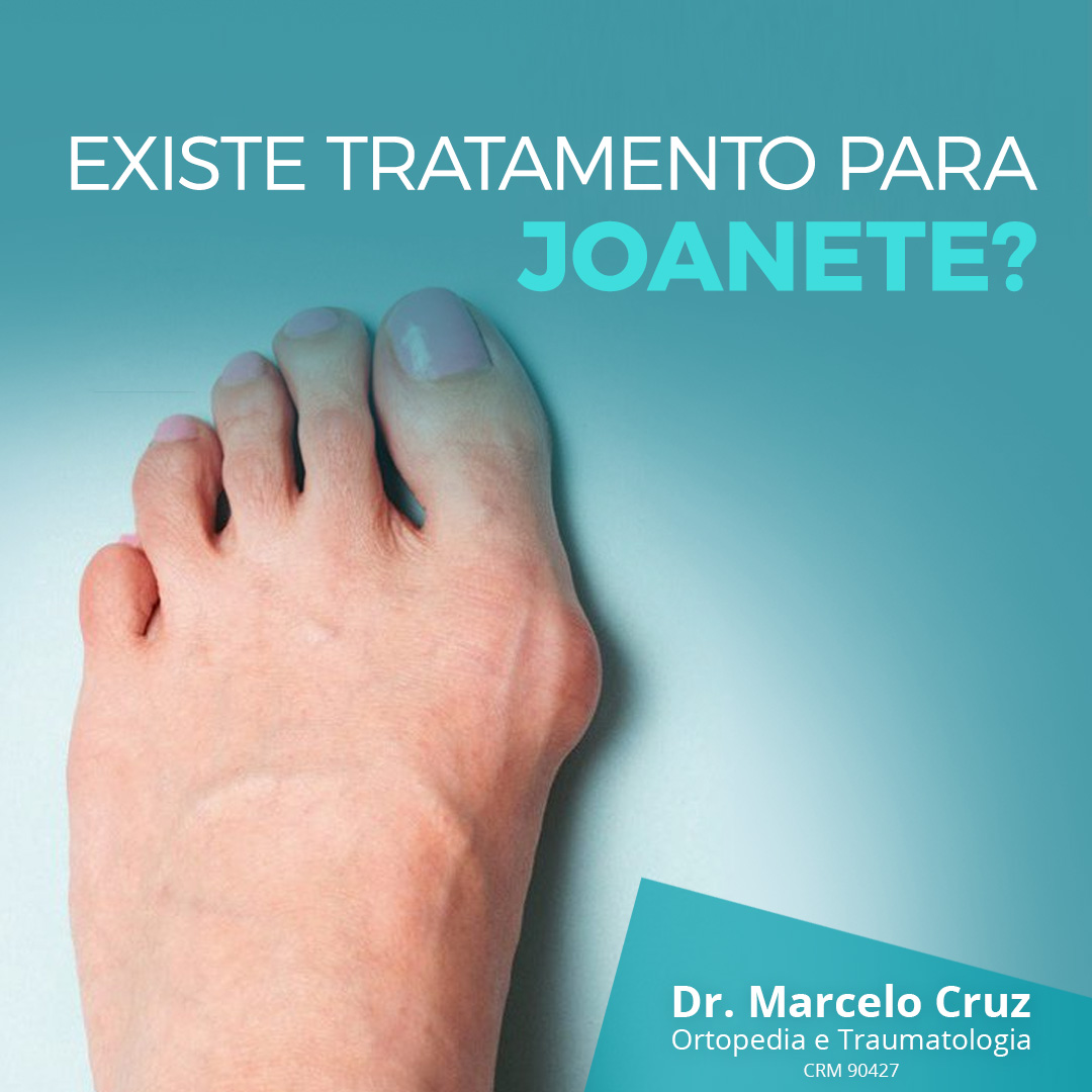 Tratar O Joanete: 3 Exercícios Que Você Precisa Conhecer! – MRQO